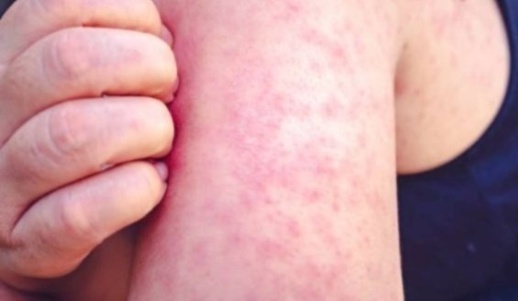 بلجيكا.. اكنتشاف سلالة مغربية من داء بوحمرون في مياه الصرف الصحي بلجيكا.. اكنتشاف سلالة مغربية من داء بوحمرون في مياه الصرف الصحي