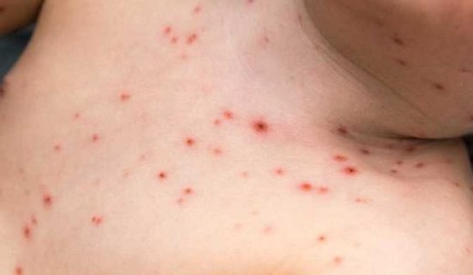 السلطات البلجيكية تشدد تدابير الوقاية بسبب سلالة السلطات البلجيكية تشدد تدابير الوقاية بسبب سلالة