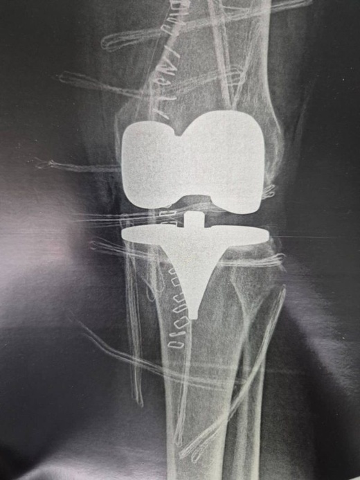 فريق طبي بالمستشفى الحسني بالناظور ينجح في استبدال كلي لمفصل ركبة مريضة ستينية فريق طبي بالمستشفى الحسني بالناظور ينجح في استبدال كلي لمفصل ركبة مريضة ستينية