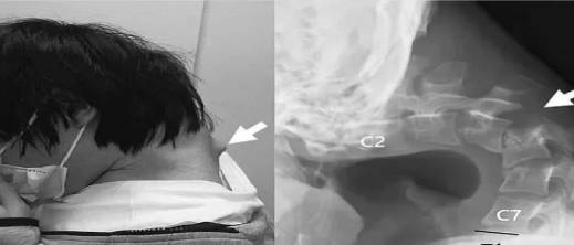 شاب يفقد القدرة على رفع رأسه بسبب الهاتف شاب يفقد القدرة على رفع رأسه بسبب الهاتف