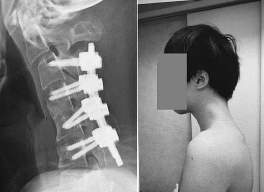 شاب يفقد القدرة على رفع رأسه بسبب الهاتف شاب يفقد القدرة على رفع رأسه بسبب الهاتف