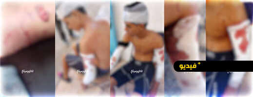 قاصر يروي تفاصيل حادث نجاته من الموت بأعجوبة بعد أن نهشت كلاب مدربة جسده أمام أنظار قاصر يروي تفاصيل حادث نجاته من الموت بأعجوبة بعد أن نهشت كلاب مدربة جسده أمام أنظار