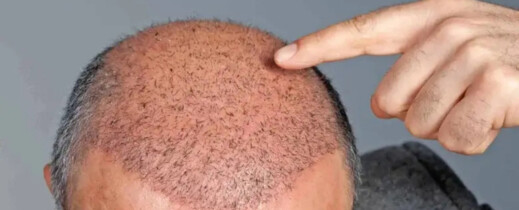 وفاة رجل أثناء التحضير لعملية زراعة شعر في تركيا وفاة رجل أثناء التحضير لعملية زراعة شعر في تركيا