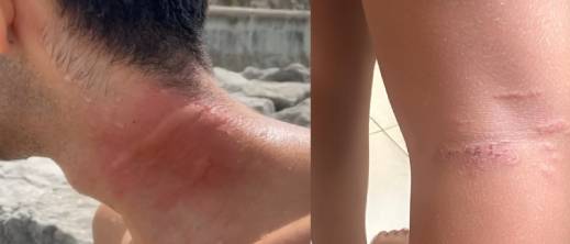 لسعات قناديل البحر تعكر صفو شواطئ مغربية وتثير قلق المصطافين لسعات قناديل البحر تعكر صفو شواطئ مغربية وتثير قلق المصطافين