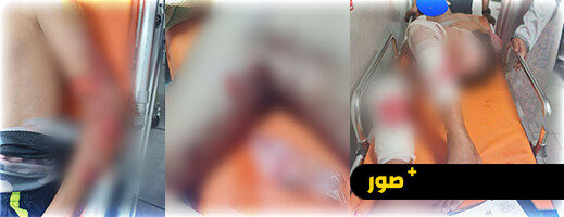على خطى طفل العروي.. هجوم شرس من كلاب ضالة على طفل بأكادير على خطى طفل العروي.. هجوم شرس من كلاب ضالة على طفل بأكادير