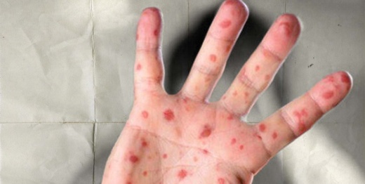 ارتفاع مفاجئ لحالات بوحمرون بإسبانيا.. والسلطات تربطها بالوافدين من المغرب ارتفاع مفاجئ لحالات بوحمرون بإسبانيا.. والسلطات تربطها بالوافدين من المغرب