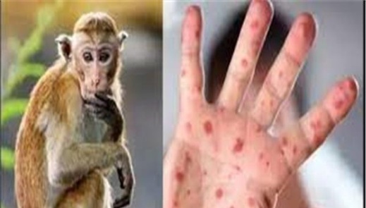 الصحة العالمية تقرر رفع حالة الطوارئ بخصوص جدري القردة