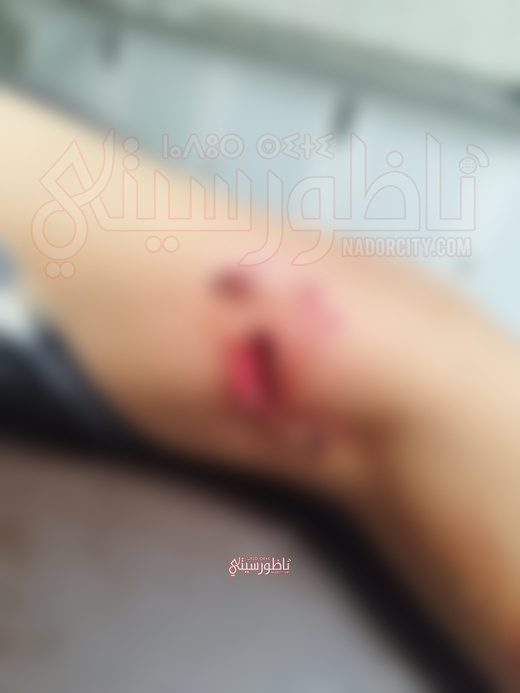 كلب ينهش طفلا بـ أفرا -الناظور.. الداخلية تستسلم لضغط الجمعيات  والمواطنون هم الحلقة الأضعف كلب ينهش طفلا بـ أفرا -الناظور.. الداخلية تستسلم لضغط الجمعيات  والمواطنون هم الحلقة الأضعف