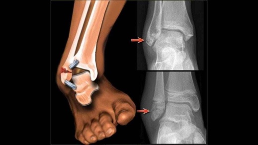 شاب من بن الطيب يواجه مصير المجهول بعد كسر.. والمستشفى يطلب الانتظار أو التوجه لمصحة خاصة