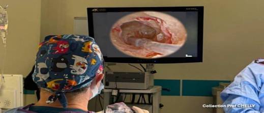 المغرب يحقق إنجازا طبيا نادرا: أول زراعة قوقعة سمعية بتقنية الأندوسكوب في المملكة