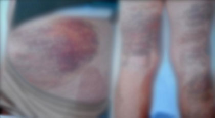 هذه آخر مستجدات قضية التلميذ الذي تعرض للتعذيب على يد معلمته بالناظور