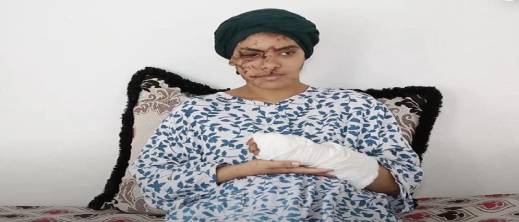 تازة: 130 غرزة على وجه إيمان.. والعدالة تقضي بالسجن 15 سنة للطليق