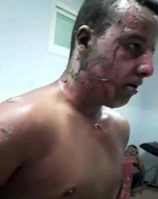 هكذا أصبحت حالة الشاب الذي أصيب بحروق متفاوتة الخطورة خلال مطاردة سلطات الناظور للفراشة