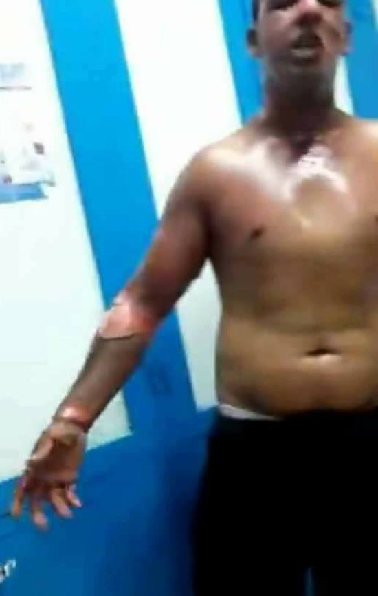 هكذا أصبحت حالة الشاب الذي أصيب بحروق متفاوتة الخطورة خلال مطاردة سلطات الناظور للفراشة