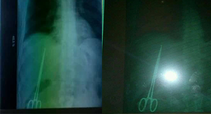 بالصور.. فضيحة تهز قطاع الصحة بالمغرب.. العثور على مقص داخل صدر مريض أجرى عملية قبل 10 سنوات