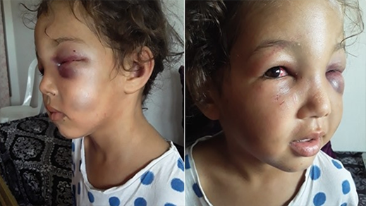 زايو.. تعذيب الطفلة “أميرة” في الخامسة من عمرها بشكل همجي زايو.. تعذيب الطفلة “أميرة” في الخامسة من عمرها بشكل همجي