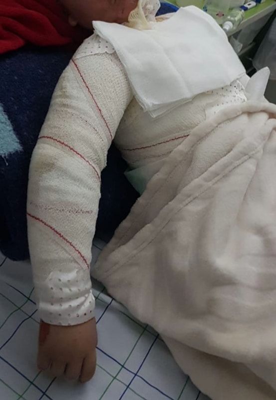 حملة تبرعات بفرنسا لإنقاذ طفل تعرض لحروق خطيرة بالناظور