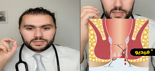 شاهدوا.. نصائح بالريفية لمرضى البواسير