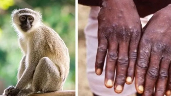 الصحة تعلن عن نتائج تحاليل الحالات المشتبه في إصابتها بجدري القرود 