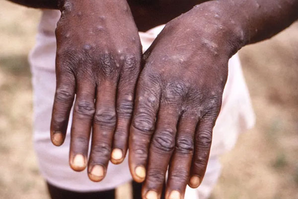 خبير يؤكد: اليقظة الصحية ونظام المراقبة بالمغرب له دور كبير في اكتشاف الحالة الأولى من جدري القردة