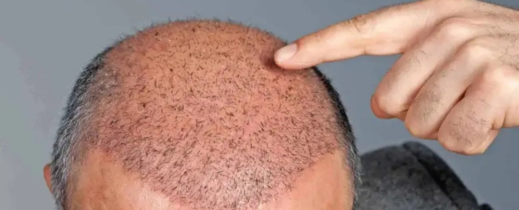وفاة رجل أثناء التحضير لعملية زراعة شعر في تركيا وفاة رجل أثناء التحضير لعملية زراعة شعر في تركيا