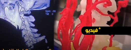 نجاة معجزة: أطباء ينجحون في إعادة تركيب الرأس بعد انفصاله عن الجسد نجاة معجزة: أطباء ينجحون في إعادة تركيب الرأس بعد انفصاله عن الجسد