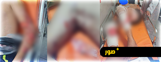 على خطى طفل العروي.. هجوم شرس من كلاب ضالة على طفل بأكادير على خطى طفل العروي.. هجوم شرس من كلاب ضالة على طفل بأكادير