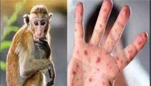 الصحة العالمية تقرر رفع حالة الطوارئ بخصوص جدري القردة الصحة العالمية تقرر رفع حالة الطوارئ بخصوص جدري القردة