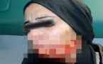 سيدة تُعرِّض وجهها للتشويه بجروح قطعية بليغة بواسطة سكين وترفض علاجها لهذا "السبب" بالناظور