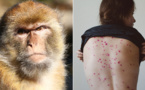 وزارة الصحة تسجل أول حالة إصابة مؤكدة بجدري القرود