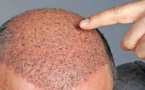 وفاة رجل أثناء التحضير لعملية زراعة شعر في تركيا