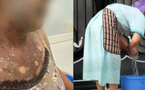 طرد عاملة منزلية بعد تعرضها لحروق بليغة واتهامها بالسرقة طرد عاملة منزلية بعد تعرضها لحروق بليغة واتهامها بالسرقة